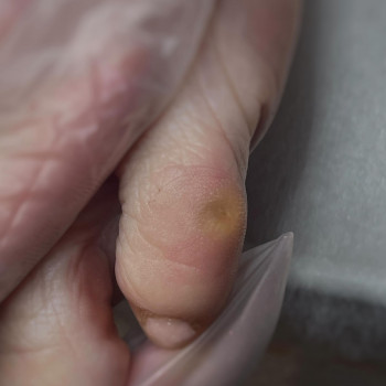 Фото з портфоліо клініки Babenko (центри подології, Білгород-Дністровський)