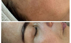 Отбеливание кожи лица Косметолог Мар'яна Трускавец