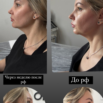 Мікро голчастий rf