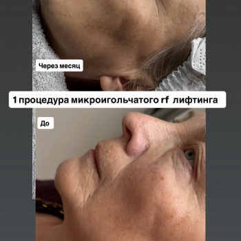 Мікроголчастий