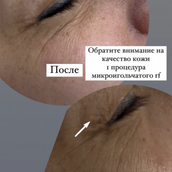 Мікроголчастий rf