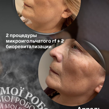 Мікроголчастий рі