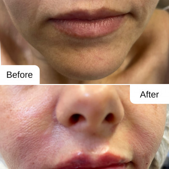 Корекція носогубних заломів