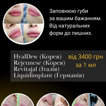 Збільшення губ