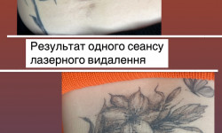 Видалення тату і татуажу Тату майстер Ірина Вінниця