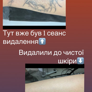 Видалення тату і татуажу
                    Тату майстер Ірина Вінниця