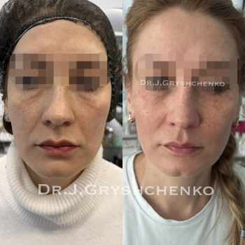 Фото після через 3 міс коли спрацював Радіесс