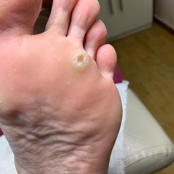 Обробка бородавок