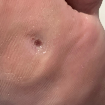 Стержневі мозолі та натоптиші