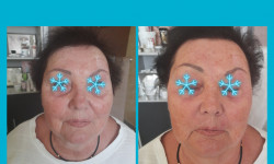 Мезотерапия Косметолог-эстетист Ирина Валерьевна Одесса