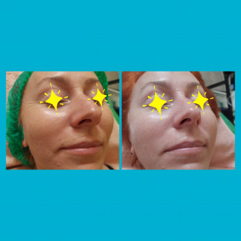   
До и сразу после процедуры