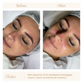 Процедура з чистки та пілінгу обличчя