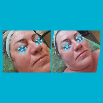  
До и після процедури