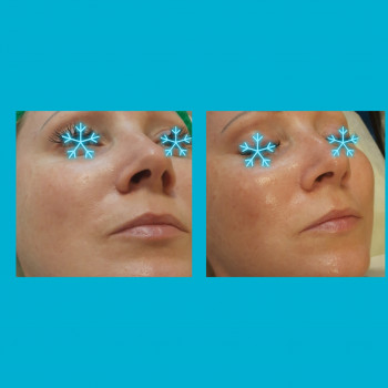  
Результат до и после первой процедуры