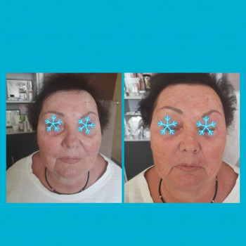  
 
 
До и после процедуры