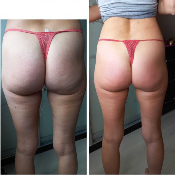 Обгортання бандажне віски пеленання STYX
                    Реабилитолог Юлия Киев