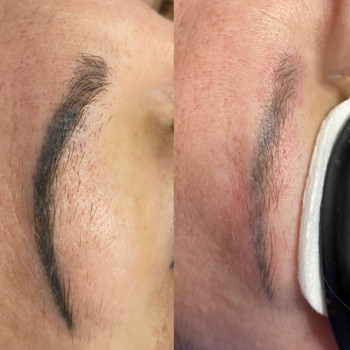 Лазерное удаление перманента и татуировок безопасно
                    Мастер перманентного макияжа Людмила Черноморск