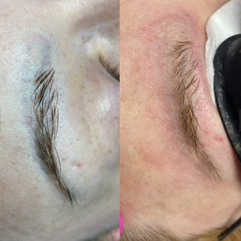 Лазерное удаление перманента и татуировок безопасно
                    Мастер перманентного макияжа Людмила Черноморск