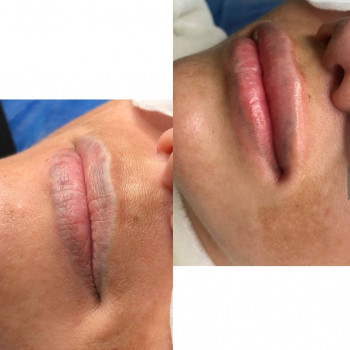 Лазерное удаление перманента и татуировок безопасно
                    Мастер перманентного макияжа Людмила Черноморск