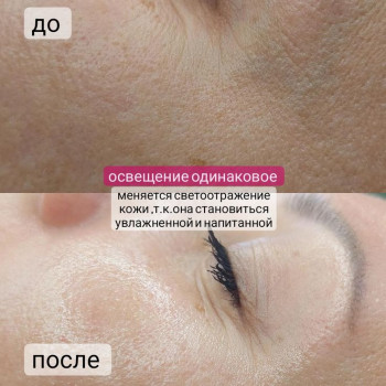 Омоложение кожи, очищение и сужение пор
                    Мастер перманентного макияжа Людмила Черноморск