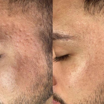 Омоложение кожи, очищение и сужение пор
                    Мастер перманентного макияжа Людмила Черноморск