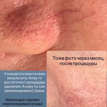 Удаление сосудов лазером
                    Майстер перманентного макіяжу Ирина Полтава