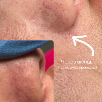 Удаление сосудов лазером
                    Майстер перманентного макіяжу Ирина Полтава