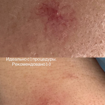 Удаление сосудов лазером
                    Майстер перманентного макіяжу Ирина Полтава