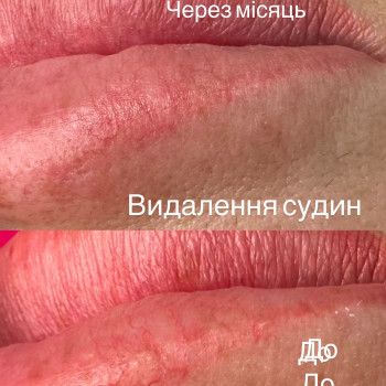Удаление сосудов лазером
                    Майстер перманентного макіяжу Ирина Полтава