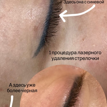 Видалення стрілки лазером
                    Майстер перманентного макіяжу Ирина Полтава