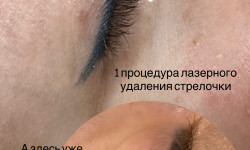 Видалення стрілки лазером Мастер перманентного макияжа Ирина Полтава