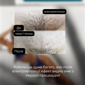Результат після першої процедури