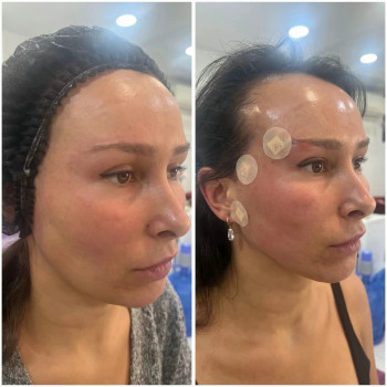 Тредліфтинг мезонитки
                    Косметолог-ін'єкціоніст Наталья Дніпро