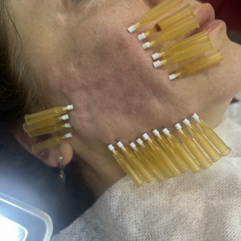 Тредліфтинг мезонитки
                    Косметолог-ін'єкціоніст Наталья Дніпро