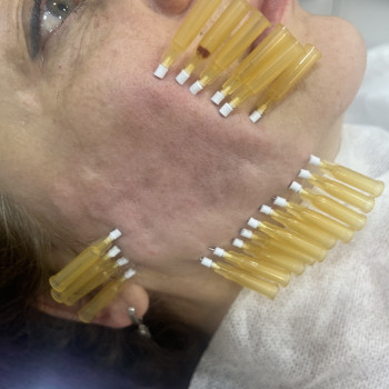 Тредліфтинг мезонитки
                    Косметолог-ін'єкціоніст Наталья Дніпро