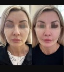 Ботокс Full face Фул Фэйс Лікар-косметолог Юлия Харків