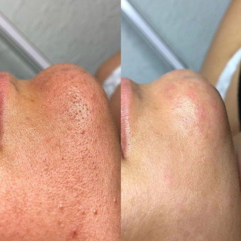 Механическая чистка лица
                    Лешмейкер Юлия Николаев