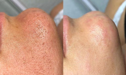 Ультразвуковая чистка лица Лешмейкер Юлия Николаев