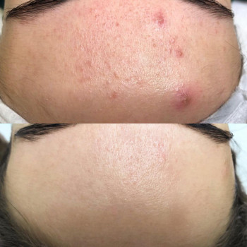 Ультразвукова чистка обличчя
                    Лешмейкер Юлия Миколаїв