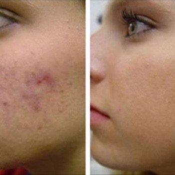 Фракційна мезотерапія
                    Лешмейкер Юлия Миколаїв