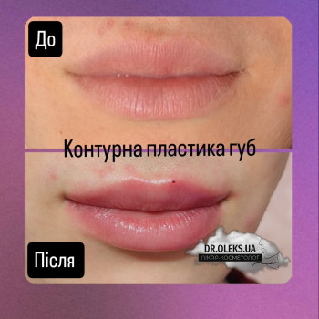 Аугментація губ. Контурна пластика губ