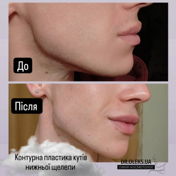 Контурна пластика кутів нижньої щелепи