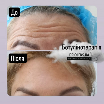 Ботокс чола. Ботокс лоба.