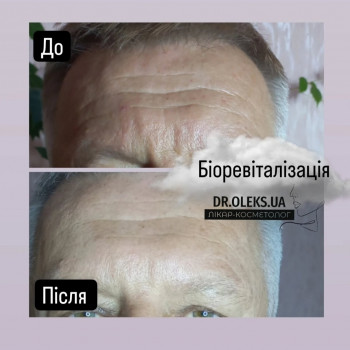 Біоревіталізація — це ін'єкційна косметологічна процедура для глибокого зволоження та омолодження шк...