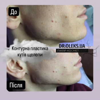 Кут Джолі. (Контурна пластика кутів нижньої щелепи)