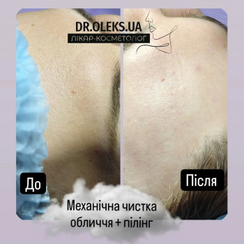 Чистка обличчя. Пілінг обличчя.