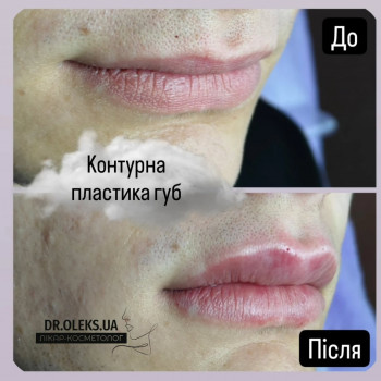 Аугментація губ. Контурна пластика губ
