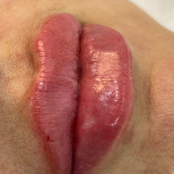 Контурна пластика губ