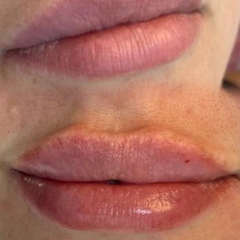 Контурна пластика губ