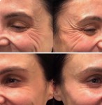 Ботокс -4 зони -40% Врач-косметолог Натали Киев